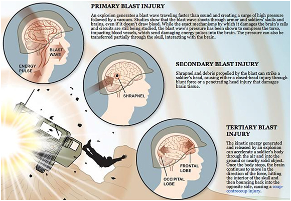 Image of TBI